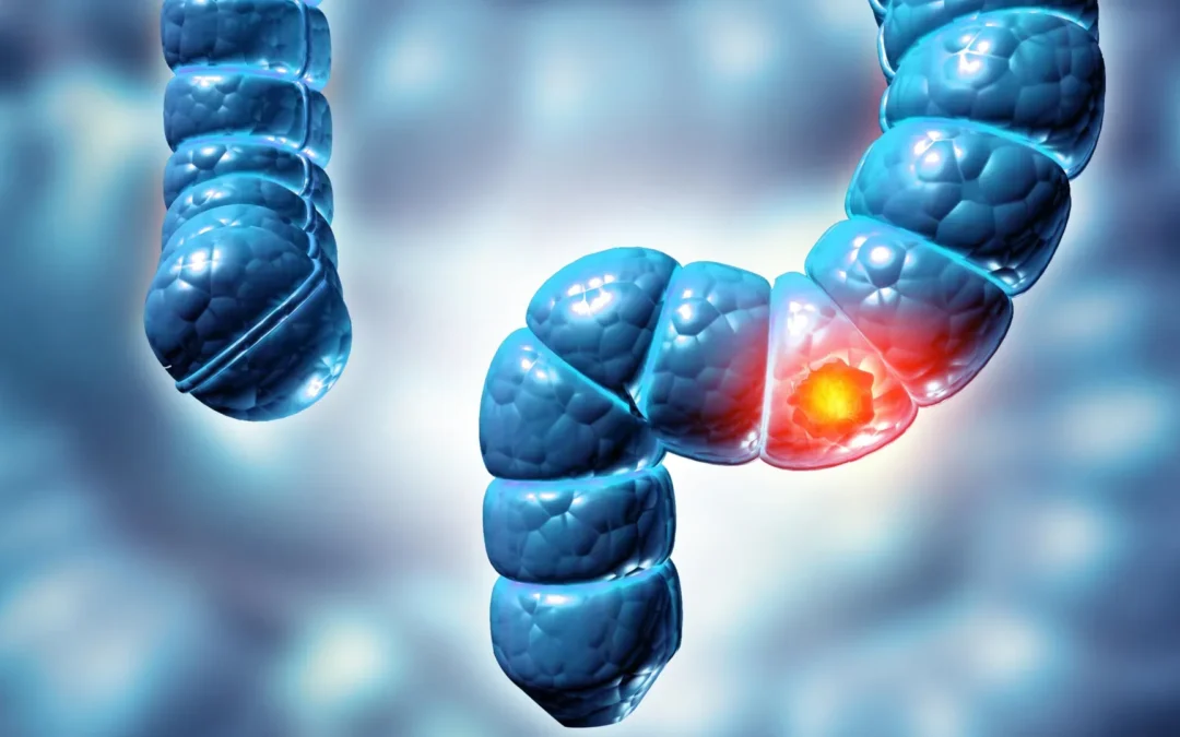 Two Colon Polyps Together May Raise Bowel Cancer Risk Fivefold