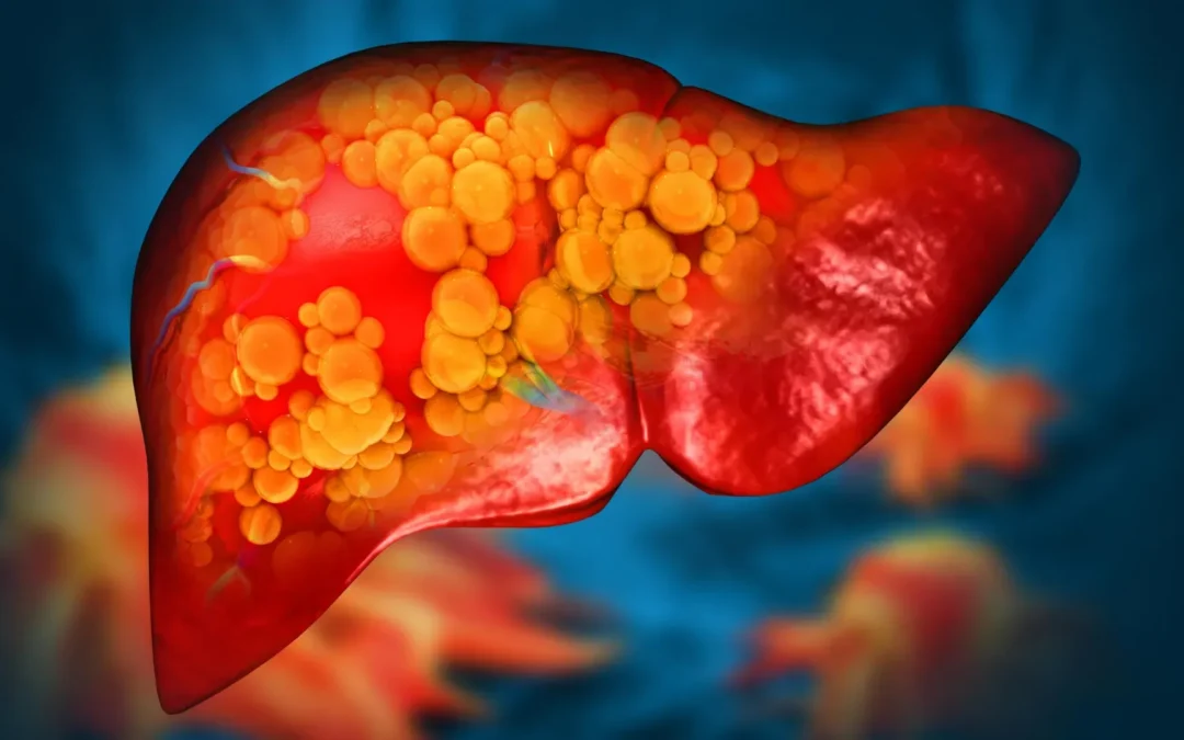 Rare Gene Mutation Linked to Fatty Liver Disease