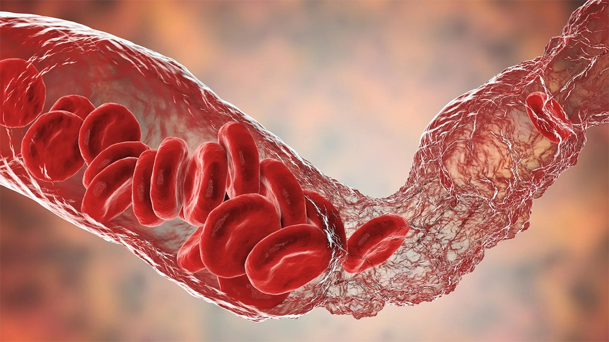 vasoconstriction-blood-clot-formation-thromboembolism